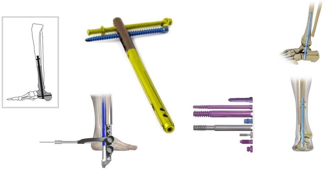 Переломи пʼяткової кістки: коли опора стопи потребує відновлення