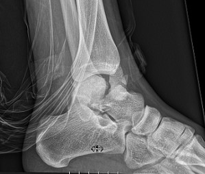 Переломи таранної кістки: сучасні аспекти діагностики та лікування