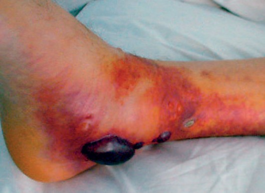 Типовий вигляд стопи при травматичних пошкодженнях таранної кістки