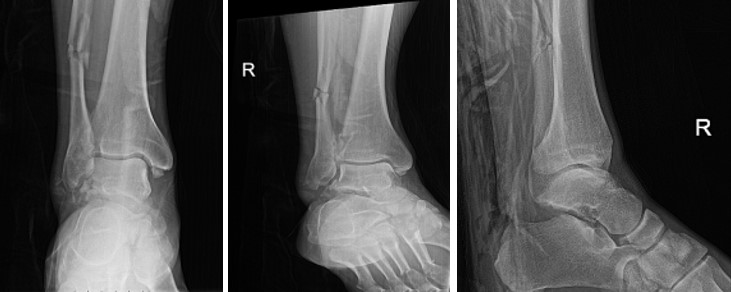 Переломи таранної кістки: сучасні аспекти діагностики та лікування