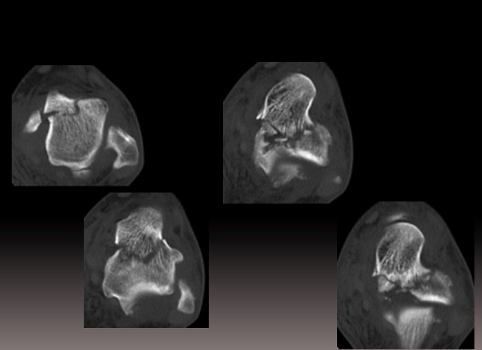 Переломи таранної кістки: сучасні аспекти діагностики та лікування
