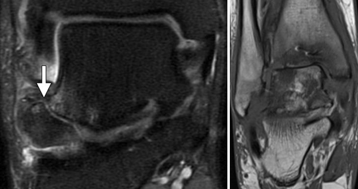 Переломи таранної кістки: сучасні аспекти діагностики та лікування