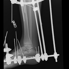 Переломи таранної кістки: сучасні аспекти діагностики та лікування