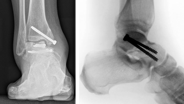 Переломи таранної кістки: сучасні аспекти діагностики та лікування