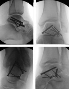 Переломи таранної кістки: сучасні аспекти діагностики та лікування
