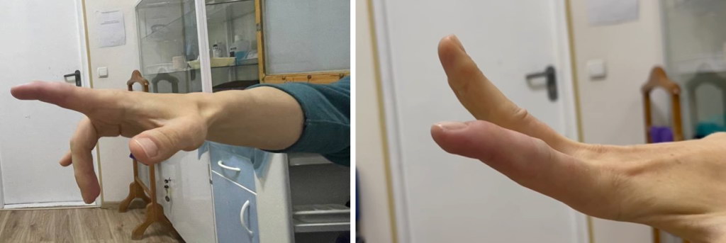  Пошкодження сухожилків розгиначів пальців кисті на рівні дистальної фаланги