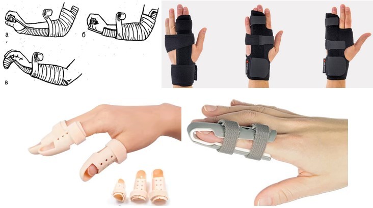  Пошкодження сухожилків розгиначів пальців кисті на рівні дистальної фаланги