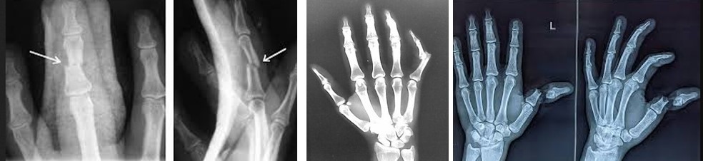  Пошкодження сухожилків розгиначів пальців кисті на рівні дистальної фаланги