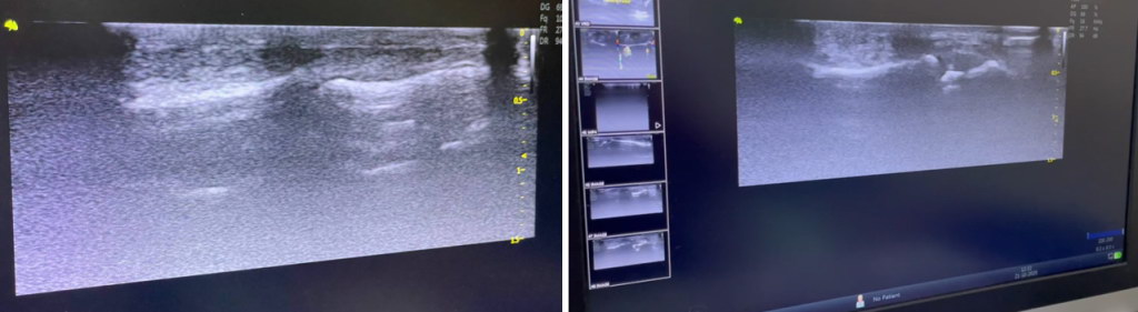 Пошкодження  дистального ентеза сухожилка довгого розгинача 2 пальця. УЗД.