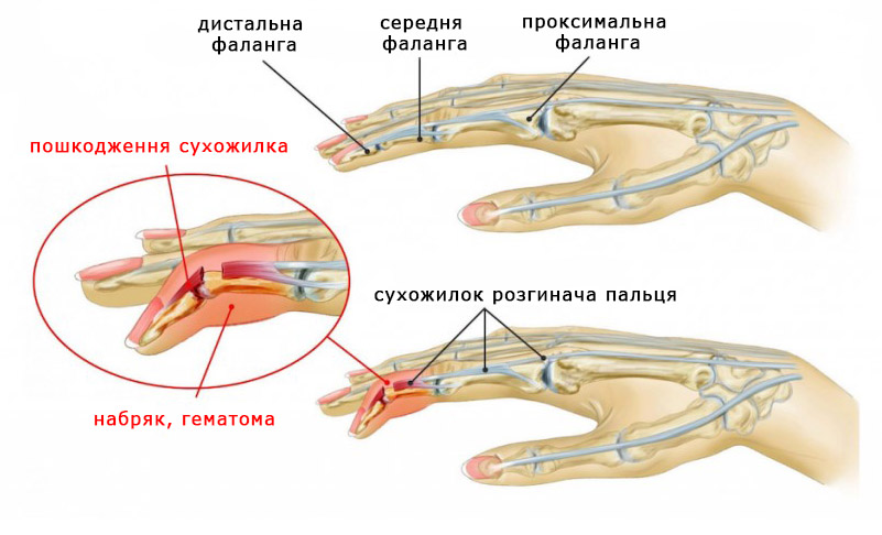 Пошкодження сухожилків розгиначів пальців кисті на рівні дистальної фаланги