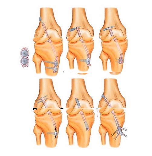 Методи фіксації сухожилкового трансплантату «нової» хрестоподібної зв’язки до стегнової та великогомілкової кісток