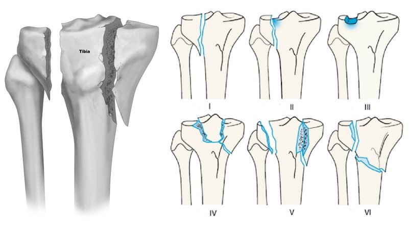 Переломи проксимального відділу гомілки. Сучасний підхід у діагностиці та лікуванні