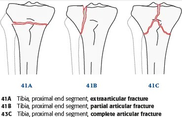 Класифікація за AO/ASIF. Type A: Extraarticular fracture (41-A), Type B: Partial articular fracture (41-B), B1: Pure split, B2: Pure depression, B3: Split depression, Type C: Complete Articular fracture (41-C), C1: Simple articular, Simple metaphyseal, C2: Simple articular, Multi-fragmentary metaphyseal, C3: Multifragmentary articular