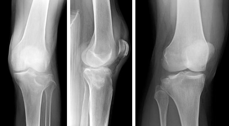 Променева діагностика переломів проксимального відділу кісток гомілки