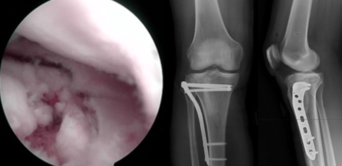 Переломи проксимального відділу гомілки. Сучасний підхід у діагностиці та лікуванні.