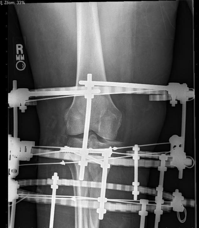 Апарати зовнішньої фіксації