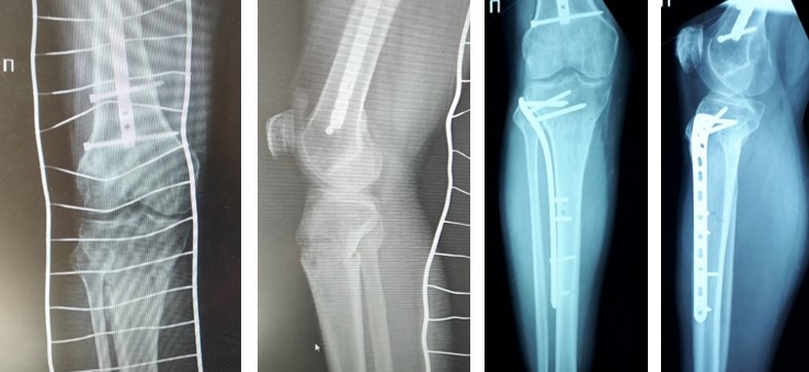 Відкрита репозиція та внутрішня фіксація залишається золотим стандартом лікування. 