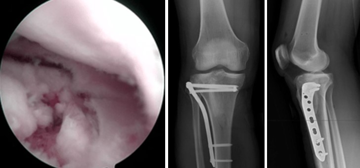 Переломи проксимального відділу гомілки становлять значну проблему сучасної травматології та ортопедії та складають близько 1,2% усіх переломів кісток. 