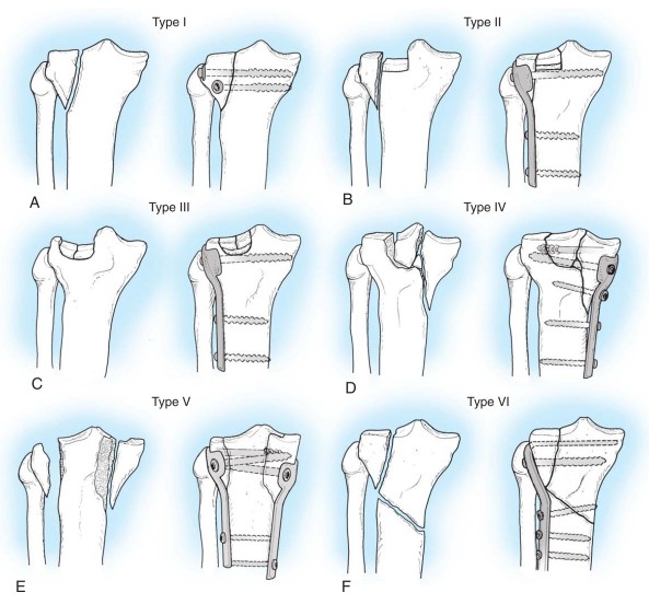 Переломи проксимального відділу гомілки. Сучасний підхід у діагностиці та лікуванні.
