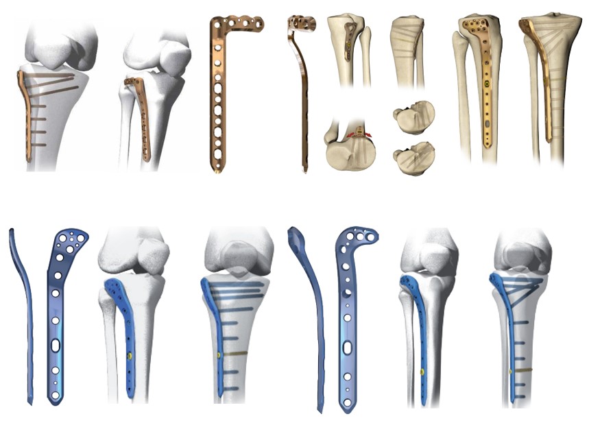 Переломи проксимального відділу гомілки. Сучасний підхід у діагностиці та лікуванні.