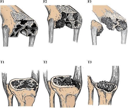 Fig. 1. AORI classification of bone defects 28