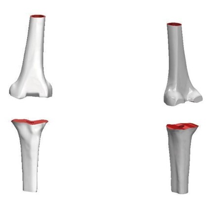 Fig. 2. Model of femur and tibia with grade III defect