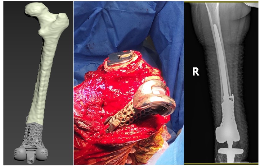 Fig. 6. Process of modeling and implantation of a custom-made femur augment for knee arthroplasty