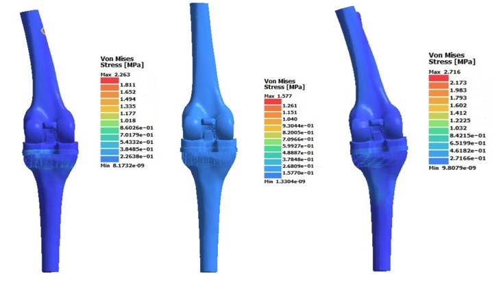 Fig. 7. The stress of a custom prosthesis when a mass of 90 kg is applied