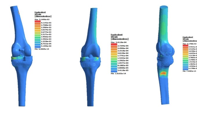 Fig. 8. Deformation of the prosthetic knee joint