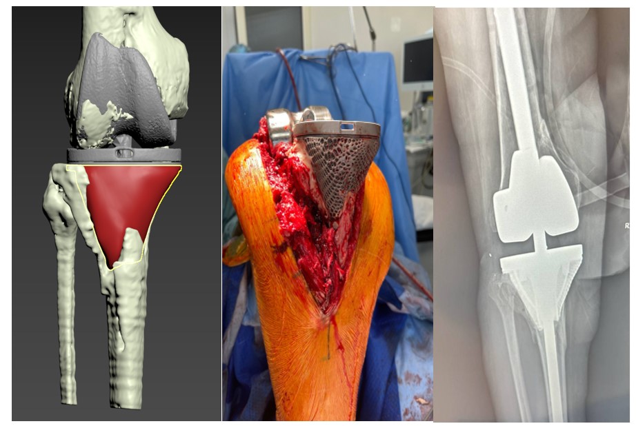 Fig. 9. Process of modeling and implantation of a personalized porous titanium augment in endoprosthetics of patients with megadefects
