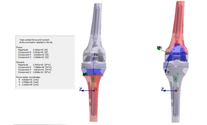 Fig. 14. The action of reaction forces on implant components