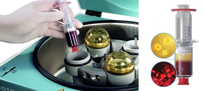 Аутологічна кондиційована плазма (ACP - Autologous Conditioned Plasma)