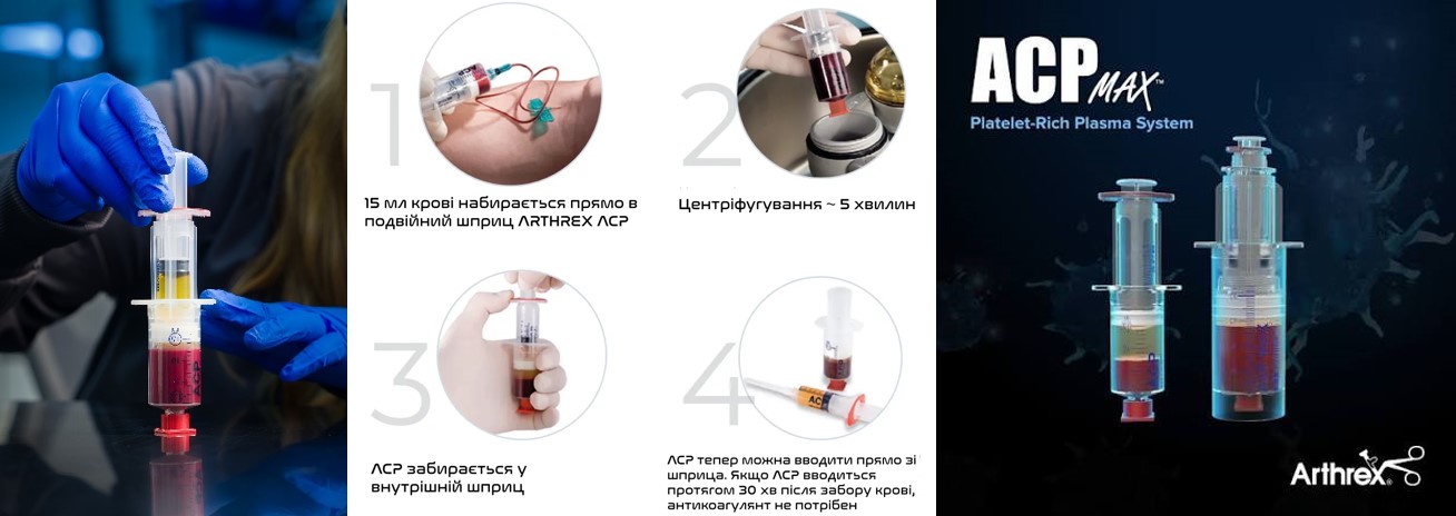 &laquo;Регенеративні технології у лікуванні асептичного некрозу кісток різної локалізації &ndash; тенденції 2026 - 2027 років&raquo;. Регенеративні технології  - Аутологічна кондиційована плазма