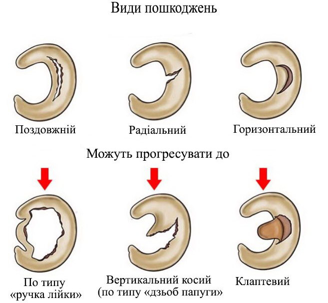 Види ушкоджень менісків (схематично)
