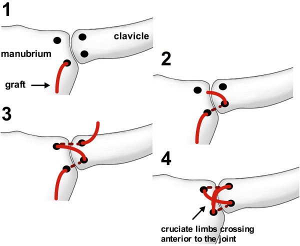 Відкрите вправлення вивиху стернального кінця ключиці, пластика зв'язок стернально-ключичного суглоба сухожилком m.palmaris longus зліва