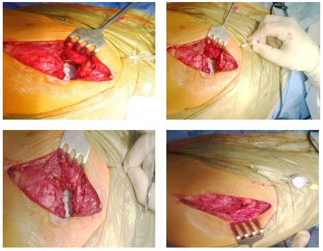 Рис. 1. Етапи введення епідурального катетеру в операційну рану інтраопераційно