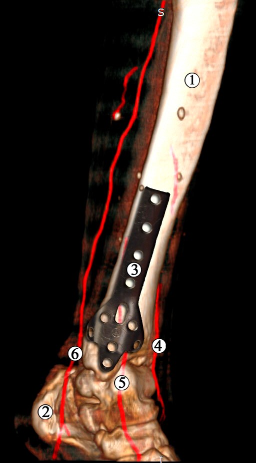 Рис. 1 Модель остеосинтезу великогомілкової кістки пластиною типу листка конюшини. Ділянка нижньої третини та гомілково-стопного суглоба лівої нижньої кінцівки. Контрастована МРТ