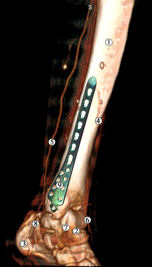 Рис. 2 Модель остеосинтезу великогомілкової кістки медіальною опорною пластиною. Ділянка нижньої третини та гомілково-стопного суглоба лівої нижньої кінцівки. Контрастована МРТ. Бічна проекція