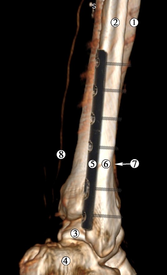 Рис. 3 Модель остеосинтезу малогомілкової кістки напівтрубчастою пластиною. Ділянка нижньої третини та гомілково-стопного суглоба правої нижньої кінцівки. Контрастована МРТ. Задньо-бічна проекція