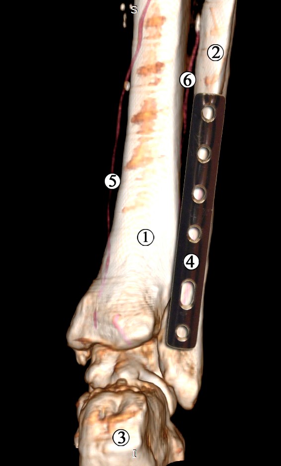 Рис. 4 Модель остеосинтезу малогомілкової кістки напівтрубчастою пластиною. Ділянка нижньої третини та гомілково-стопного суглоба правої нижньої кінцівки. Контрастована МРТ. Задня проекція