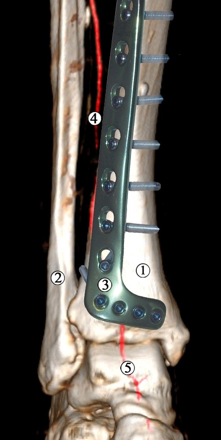 Рис. 5 Модель остеосинтезу великогомілкової кістки передньо-лате­ральною пластиною. Ділянка нижньої третини та гомілково-стопного суглоба правої нижньої кінцівки. Контрастована МРТ. Передня проекція