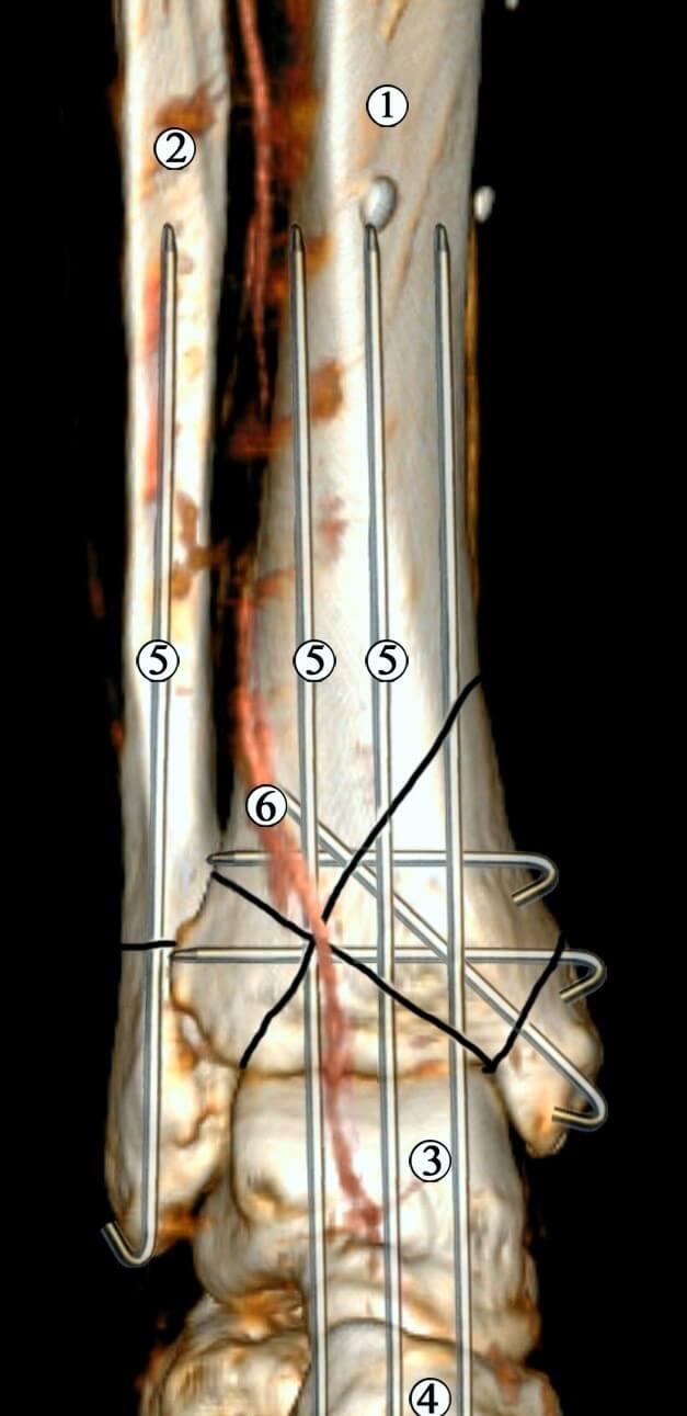 Рис. 6 Модель остеосинтезу великогомілкової кістки спицями Ілізарова та Кіршнера. Ділянка нижньої третини та гомілково-стопного суглоба правої нижньої кінцівки. Контрастована МРТ. Передня проекція