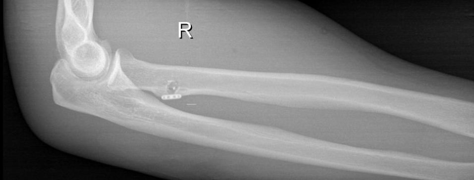 Фотовідбиток післяопераційної рентгенограми, положення Endobutton