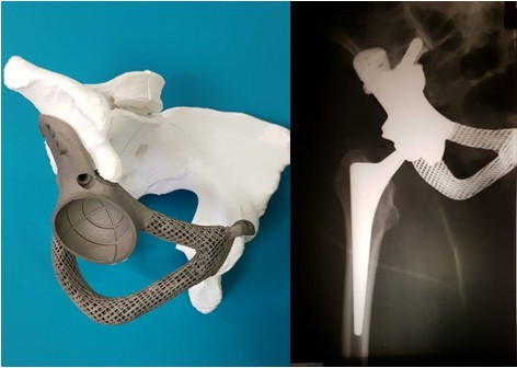 Індивідуальний титановий 3D-друкований тазовий імплантат, спроектований в лабораторії біомедичної інженерії та результат оперативного втручання, виконаного в ДУ «Інститут травматології та ортопедії НАМН України»
