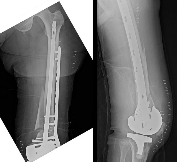 Реабилитация после перелома бедренной кости после операции