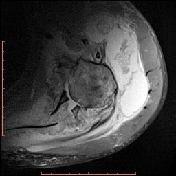 Ідіопатична сирингомієлія, патологічний перелом лопатки, остеоартропатія лівого плечового суглоба