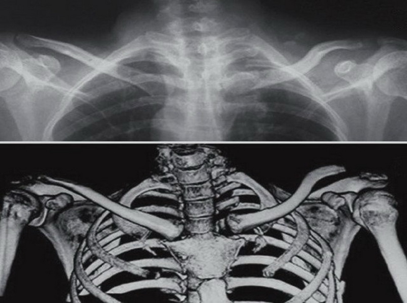 Рентген ключицы фото здоровой