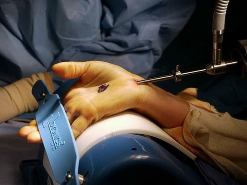 Эндоскопия отличается меньшей длиной разреза, которая составляет до 1,5 см, но проводится в двух местах. Один разрез необходим для ввода микрокамеры (эндоскопа), второй – для введения хирургического инструмента, которым, собственно, и проводится рассечение связки.  