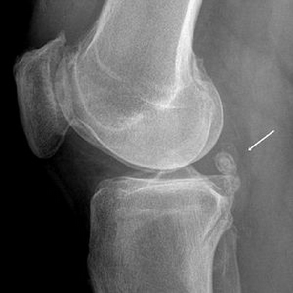 Хондроматоз коленного сустава (синовиальный остеохондроматоз, болезнь Henderson-Jones, «суставные мыши»)