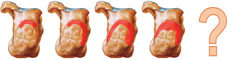 Деформация Хаглунда (синдром Хаглунда, синдром заднепяточной боли, остеофит задней части пяточной кости)